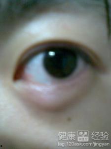 麦粒肿手术视频